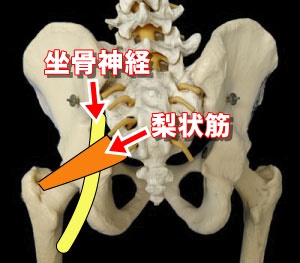 梨状筋症候群の説明画像
