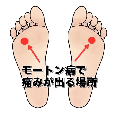 モートン病で痛みが出る場所