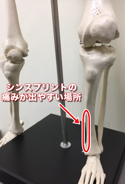 シンスプリントの痛みが出やすい場所