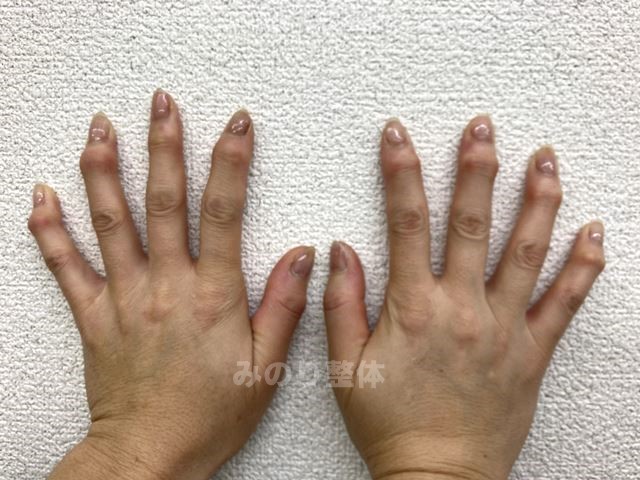 ヘバーデン結節の状態の指
